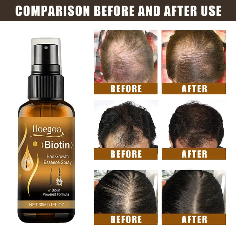 Biotin Fast Hair Growth Spray Anti Hair Loss Serum Prevent Baldness Treatment Scalp Beard Beauty Essence Hair Care Products 30ml