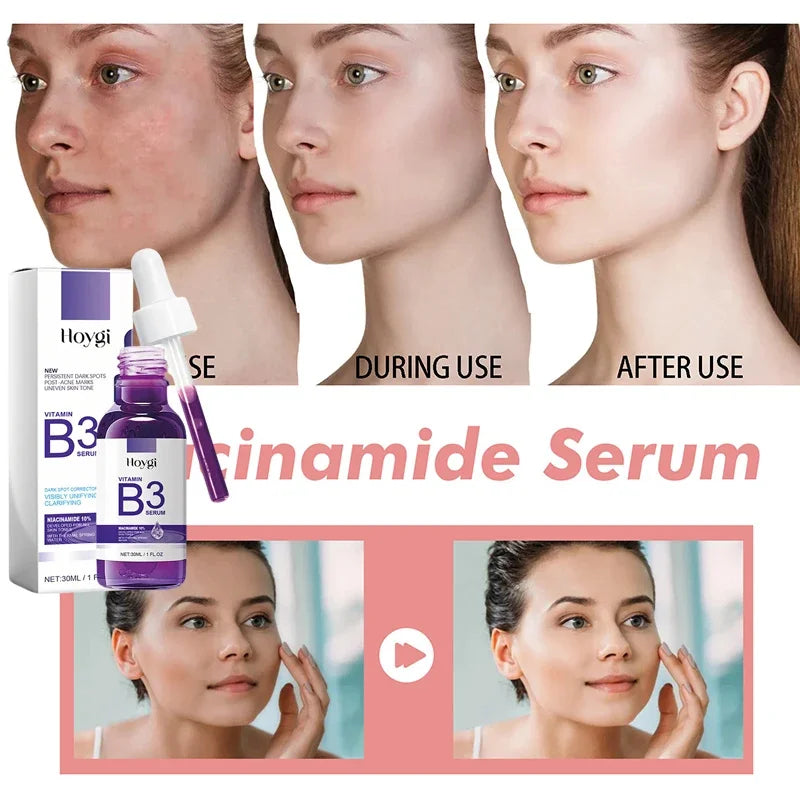Hoygi Niacinamide Facial Serum Vitamin B3 Wrinkles Pigment Dark Spot Removal Correcting Glow Serum Face Whitening Moisturizer