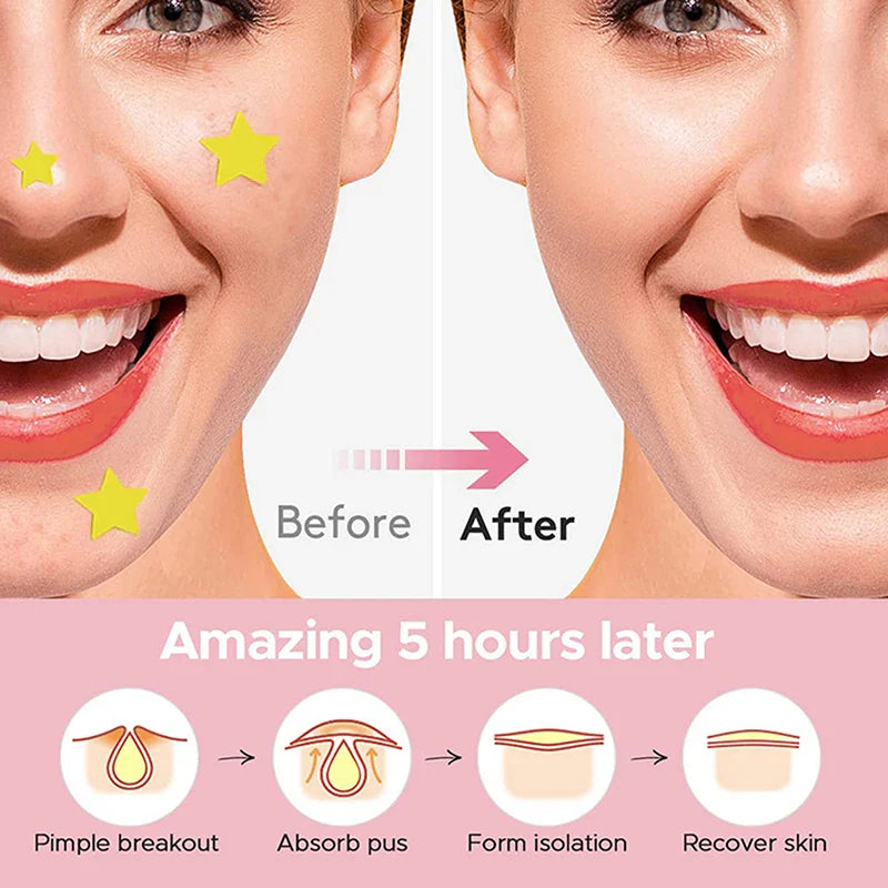 Pimple Patch Acne Colorful Invisible Acne Removal Skin Care Stickers Concealer Face Spot Beauty Makeup